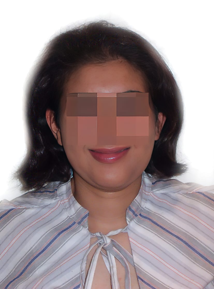 After Picture - Androgenetic Alopecia / Stress